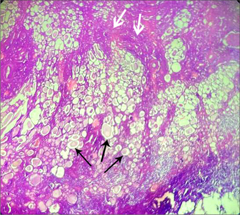 A 55-year-old female with renal replacement lipomatosis of right kidney. Histology slide prepared from the resected diseased kidney, stained with hematoxylin and eosin stain and observed at 10 × 4 magnification. Extensive clusters of well-demarcated mature adipose cells can be seen (black arrows) with interspersed fibrous septae (white arrows). Note the adipocytes have nuclei pushed to the periphery and centrally placed large lipid droplets (black arrows). No cytological atypia was seen.