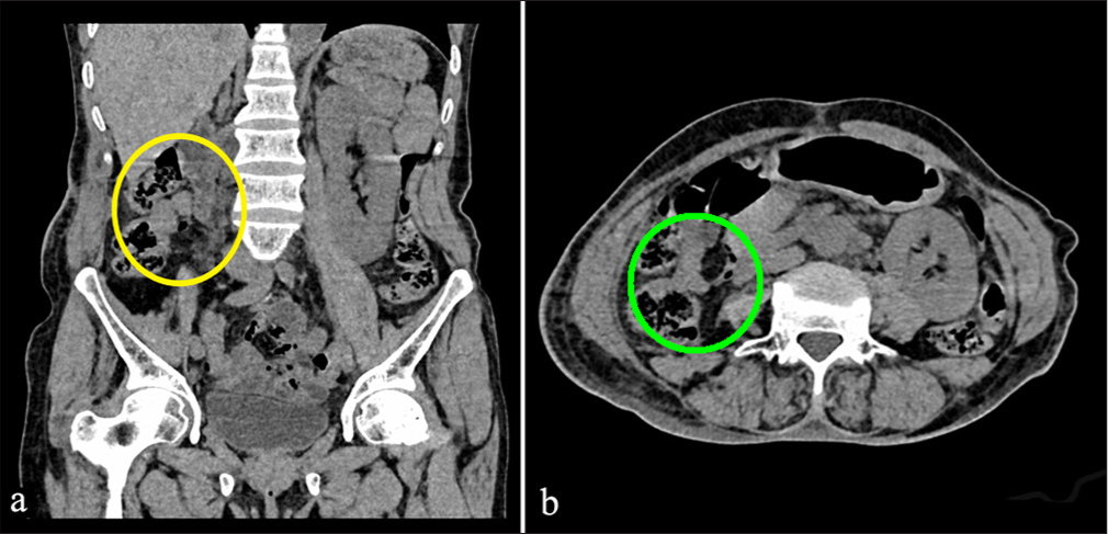 A 55-year-old female with right renal replacement lipomatosis at 3-month follow-up post-operative after laparoscopic right nephrectomy. (a) Plain computed tomography coronal section showing absence of right kidney and peri renal tissue depicted by yellow circle. (b) Same computed tomography in axial view at the level of L2 showing no residual disease (green circle).