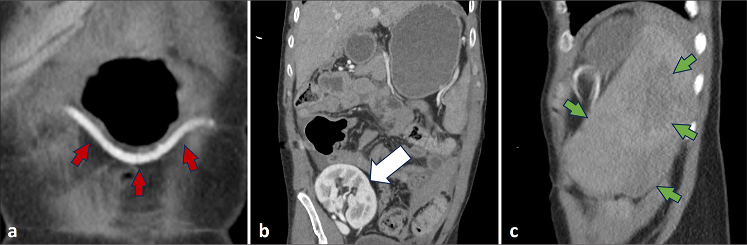 A 30-year-old male presented with chest and shoulder pain after motorcycle accident. (a) Hypertrophied gastroepiploic artery (red arrows) anastomosing with distal splenic artery at splenic hilus seen on coronal CT slice. (b) Transplanted kidney (white arrow) seen on coronal CT slice. (c) Grade V subcapsular splenic lacerations (green arrows) seen on sagittal CT slice.