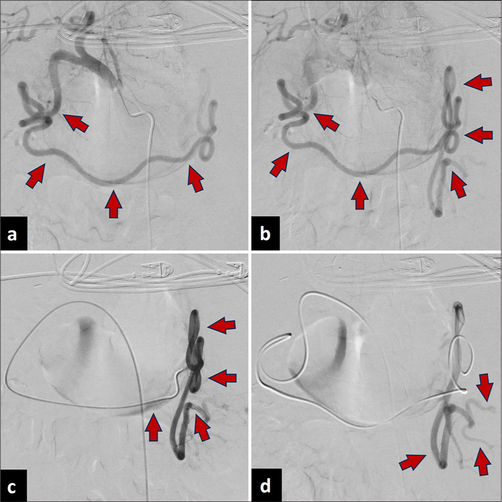 A 30-year-old male presented with chest and shoulder pain after motorcycle accident. (a-d) Arteriography demonstrates dilated and tortuous GEA reaching until the splenic hilus (red arrows).