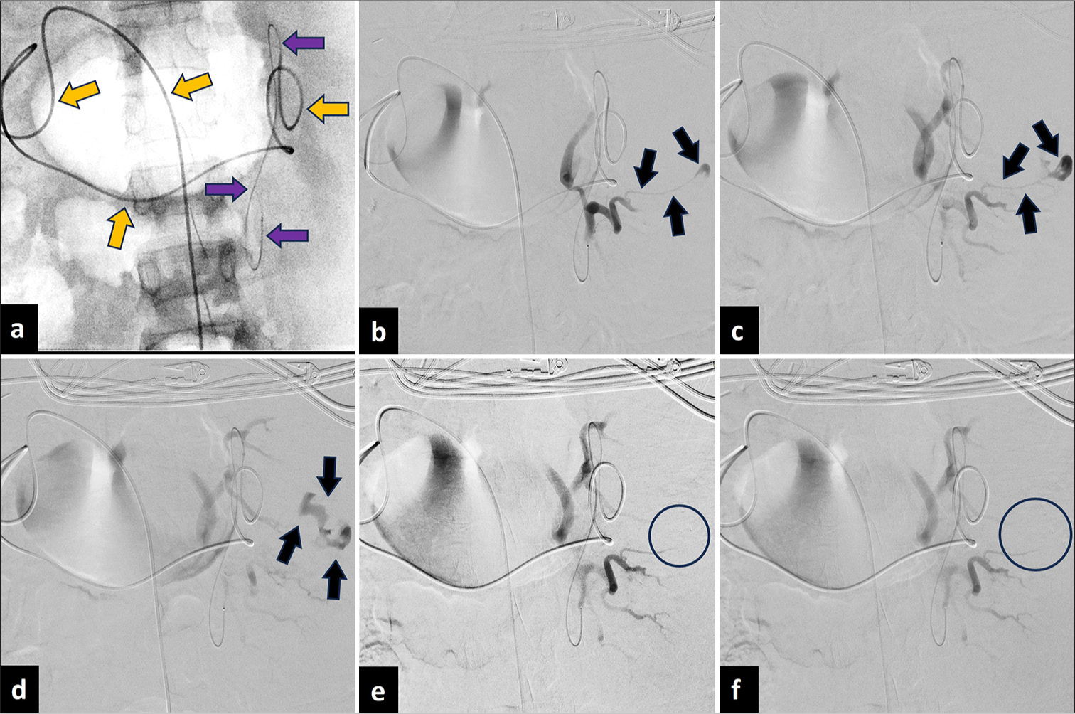 A 30-year-old male presented with chest and shoulder pain after motorcycle accident. (a) Embolization using coaxial catheter (orange arrows)/microcatheter (purple arrows) system purposefully advanced close to splenic hilus to avoid needless embolization of gastric and superior pancreaticoduodenal segments arising from right GEA. (b-d) Contrast extravasation pre-embolization (black arrows), (e-f) no longer seen post-embolization (black circles).