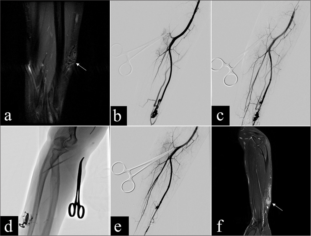 A 28-year-old male (Patient 11) diagnosed with arteriovenous malformations (AVMs) on the ulnar side of the right forearm, presenting symptoms including swelling, pain, locally elevated skin temperature, and palpable pulsation, classified as type IIIb. (a) Coronal T2-weighted magnetic resonance imaging (MRI) sequence revealing a lesion on the ulnar side of the right forearm, with evident flow voids indicating blood vessels (yellow arrow). (b) Angiography displaying the AVM nidus (yellow arrow). (c) Post-release of spring coils via arterial access (two coils of 3 mm and one coil of 4 mm), angiography showing partial occlusion of the nidus and reduced blood flow in the AVMs. (d) Fluoroscopic image during percutaneous injection of tissue glue. (e) Post-embolization angiogram showing complete occlusion of the AVMs nidus. (f) One-month post-embolization, coronal T2-weighted MRI sequence indicating a reduction in the lesion size compared to previous images, with no visible flow voids (yellow arrow). Following the procedure, the patient experienced significant improvement in swelling, normalization of skin temperature, and basic disappearance of pain. No symptom exacerbation was observed during follow-up. The treatment outcome was categorized as “complete recovery.”