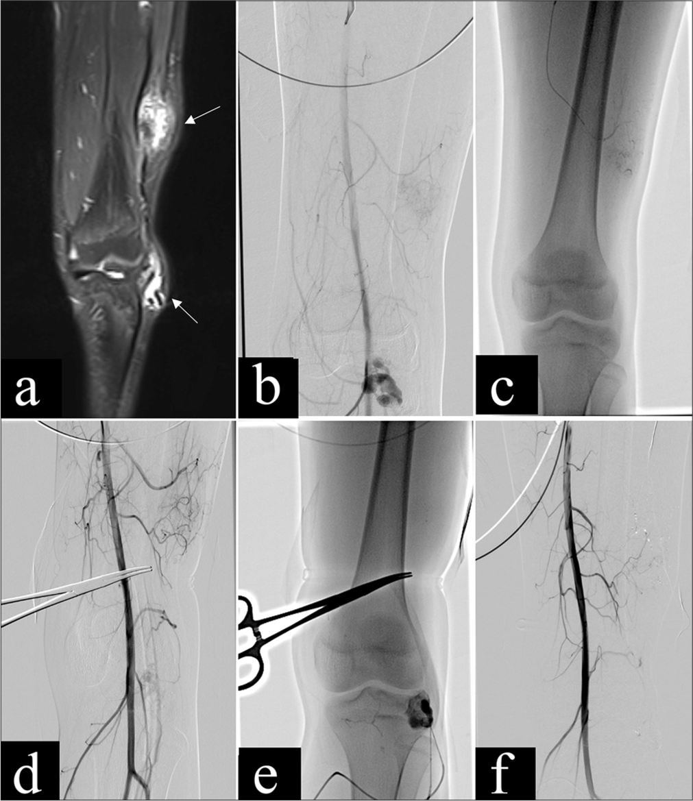 A 12-year-old girl (Patient 8) with arteriovenous malformations (AVMs) in the mid-lower segment of the left thigh and left knee joint, presenting with pulsatile masses. The AVM in the left thigh was classified as type IIIa, while the AVM in the left knee was classified as type IIIb. (a) Coronal T2-weighted magnetic resonance imaging sequence showed two lesion sites in the mid-lower segment of the left thigh and left knee joint, with visible abnormal vascular clusters (yellow arrows). (b) Angiography displayed the vascular architecture of the AVM lesions at both sites and the dilated feeding arteries and draining veins (yellow arrow). (c) Fluoroscopic image after arterial embolization using PVA and Onyx, showed cast formation within the nidus. (d) Post-arterial embolization angiogram demonstrated partial occlusion of the AVM nidus in the mid-lower segment of the left thigh. (e) Fluoroscopic image after percutaneous injection of tissue glue into the AVM nidus in the left knee joint showed n-butyl cyanoacrylate /iodized oil cast. (f) Post-embolization angiogram demonstrated complete occlusion of the AVM nidus. Following the procedure, the pulsatile masses in the left thigh and left knee decreased in size compared to before. No enlargement of the masses or other symptoms were observed during follow-up. The treatment outcome was categorized as “complete recovery.”