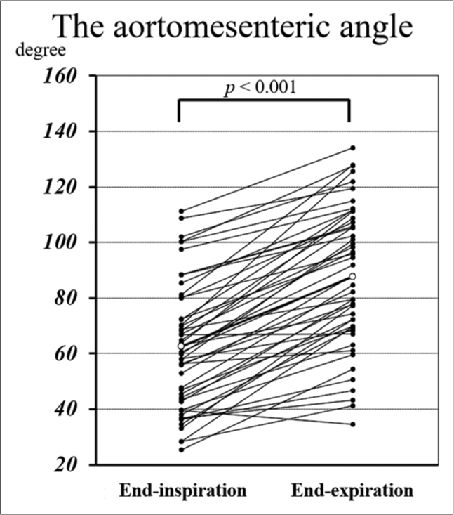 The aortomesenteric angle measurements at both end-inspiration and end-expiration were normally distributed, and the angle at end-expiration was significantly greater according to the paired t-test.