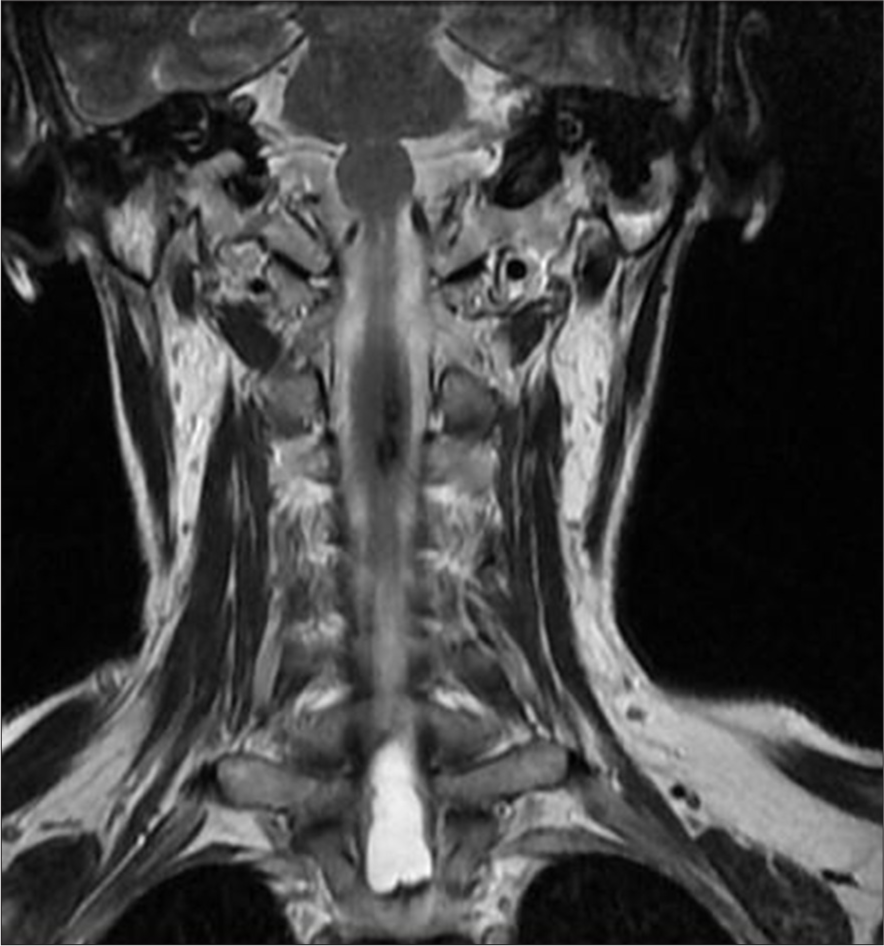 A 50-year-old female with syringomyelia. Coronal T2-weighted magnetic resonance imaging of the cervicothoracic spine reveals an elongated intramedullary lesion involving the distal medulla, cervical, and upper thoracic spinal cord. The lesion exhibits high-signal intensity and demonstrates fluid-fluid levels.
