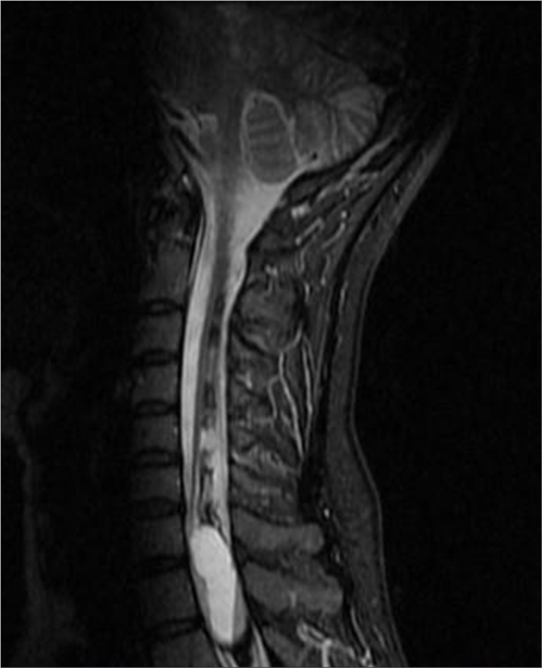 A 50-year-old female with syringomyelia. Sagittal short tau inversion recovery magnetic resonance imaging of the cervicothoracic spine demonstrates an expansile intramedullary lesion measuring 12 × 36 mm. The lesion contains fluid-fluid levels separated by a thin septum, consistent with giant hemorrhagic syringomyelia and hematomyelia.