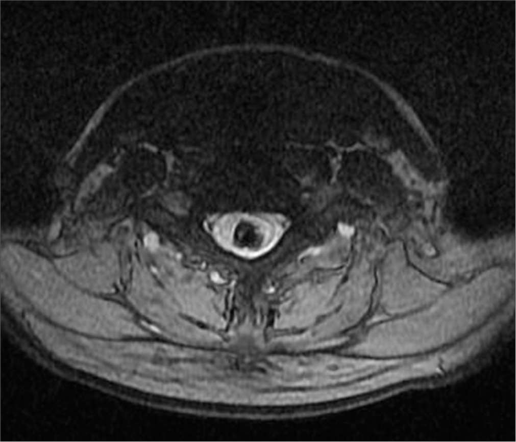 A 50-year-old female with syringomyelia. Axial T2-weighted magnetic resonance imaging of the cervicothoracic spine shows an elongated intramedullary lesion with low-signal intensity and hemorrhagic characteristics. A thin septum divides the lesion, further supporting the diagnosis of hemorrhagic syringomyelia.