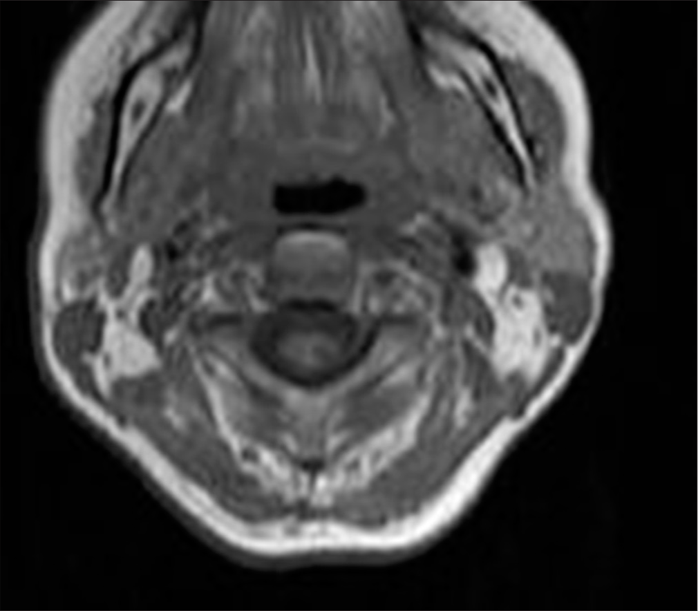 A 50-year-old female with syringomyelia. Axial T1-weighted magnetic resonance imaging of the cervicothoracic spine demonstrates low-signal intensity within the intramedullary lesion, exhibiting hemorrhagic characteristics and fluid-fluid levels between the C7 and Th3 vertebral levels.