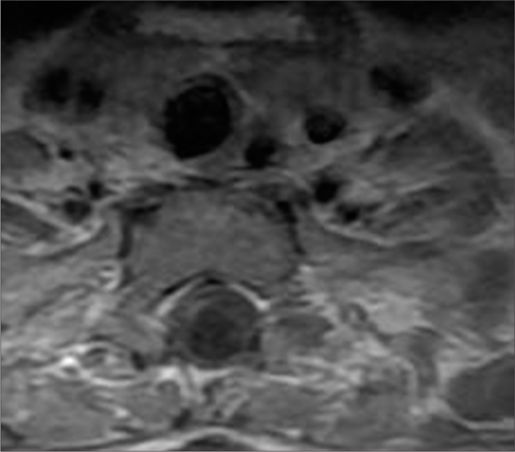 A 50-year-old female with syringomyelia. Post-contrast sagittal T1-weighted magnetic resonance imaging reveals an expansile intramedullary lesion between the C7 and Th3 vertebrae, demonstrating hemorrhagic signal characteristics without contrast enhancement.