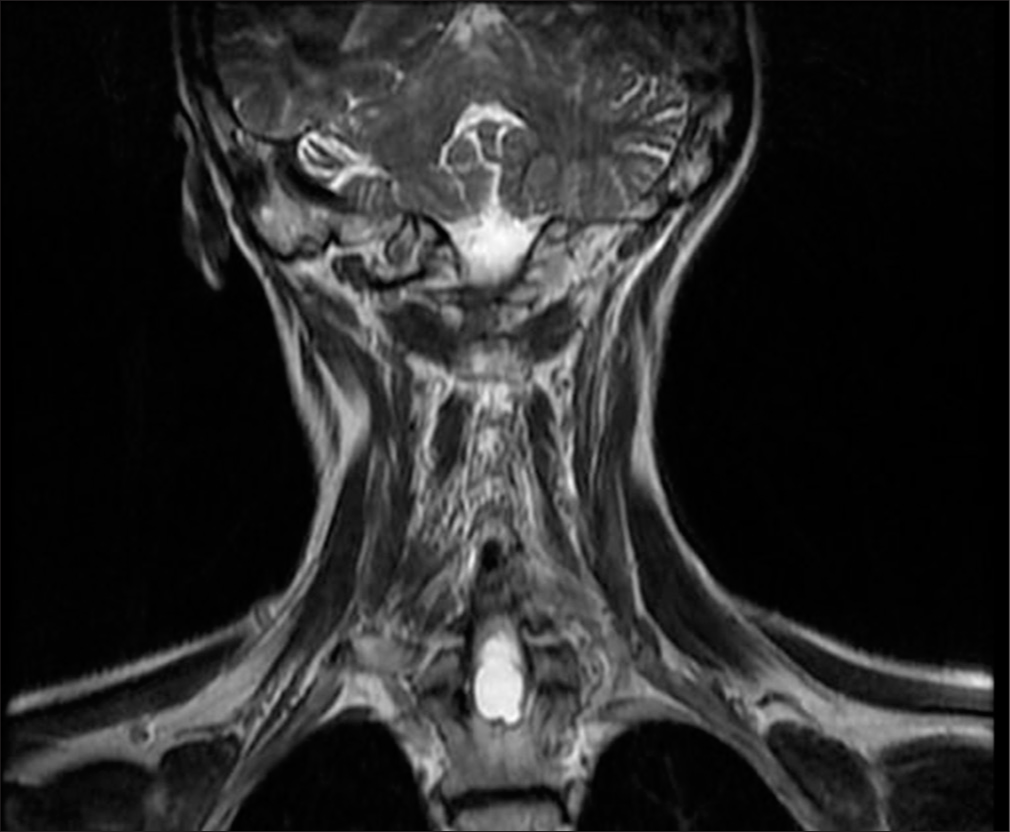 A 50-year-old female with syringomyelia. Post-operative T2-weighted coronal plane magnetic resonance imaging shows a multilobulated, expansile, hyperintense intramedullary lesion between the Th1 and Th2 vertebrae, measuring 20x13 mm, indicating a residual syringomyelia.