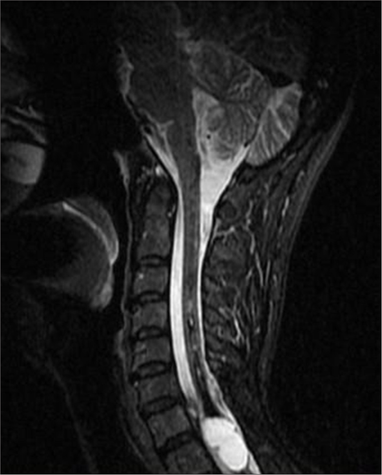 A 50-year-old female with syringomyelia. Post-operative short tau inversion recovery sagittal plane magnetic resonance imaging demonstrates decreased signal intensity in the cervical spinal cord, indicating a reduction in the syringomyelia following surgery.