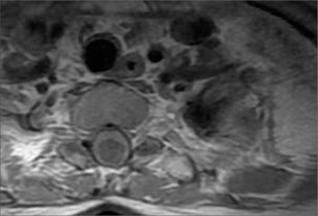 A 50-year-old female with syringomyelia. T1-weighted post-contrast axial magnetic resonance imaging reveals peripheral contrast enhancement around the lesion between Th1 and Th2, suggesting the presence of a vascular malformation.