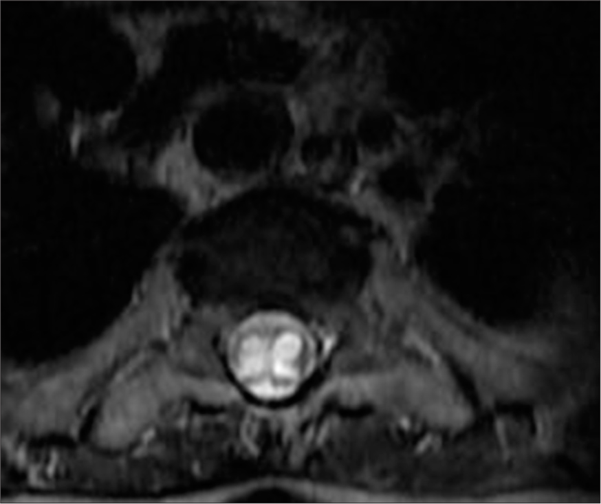 A 50-year-old female with syringomyelia. T2-weighted axial post-op magnetic resonance imaging shows reduced spinal cord thickness and a remaining expansile hyperintense lesion between Th1 and Th2, consistent with residual syringomyelia.