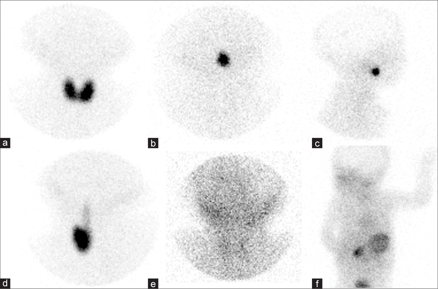 (a) [99mTc] pertechnetate thyroid scan showed marked bilateral thyroid lobe activity in the neck. This suggested thyroid eutopia. (b and c) [99mTc] pertechnetate thyroid scan showed a marked focal activity in the sublingual region, while there was no activity in the anatomical thyroid bed. This suggested thyroid dysgenesis (thyroid ectopia). (d) [99mTc] pertechnetate thyroid scan showed an absent left thyroid lobe, as evidenced by ultrasonography. This suggested thyroid dysgenesis (hemiagenesis). There was tubular activity in the upper to mid-neck, persistent after drinking water (images not shown), likely representing thyroglossal duct. (e and f) [99mTc] pertechnetate thyroid scan showed no thyroid activity in the neck and the absence of thyroid tissue was confirmed with ultrasonography. This suggested thyroid dysgenesis (athyreosis).