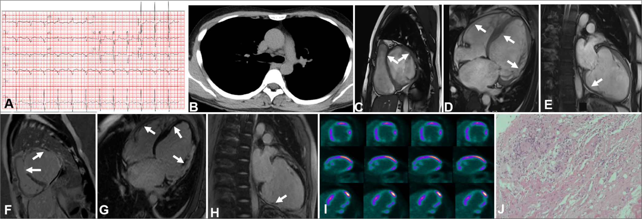 Imaging findings for a 37-year-old patient in the late phase of cardiac sarcoidosis (CS). (A) First-degree atrioventricular block and abnormal P and Q waves were observed. (B) Computed tomography results were negative. (C-H) Cardiac magnetic resonance (MR) revealed general thinning of the ventricular wall and late gadolinium enhancement in the interventricular septum, right ventricle, and ventricular free walls (white arrow). (I) 18F-fluorodeoxyglucose-positron emission tomography unveiled fixed perfusion defects corresponding to the affected areas seen in MR imaging. (J) Pathological images displayed the advanced phase of CS, which was characterized primarily by myocardial fibrosis with granulomas and chronic inflammation ((Hematoxylin-eosin HE), x10).