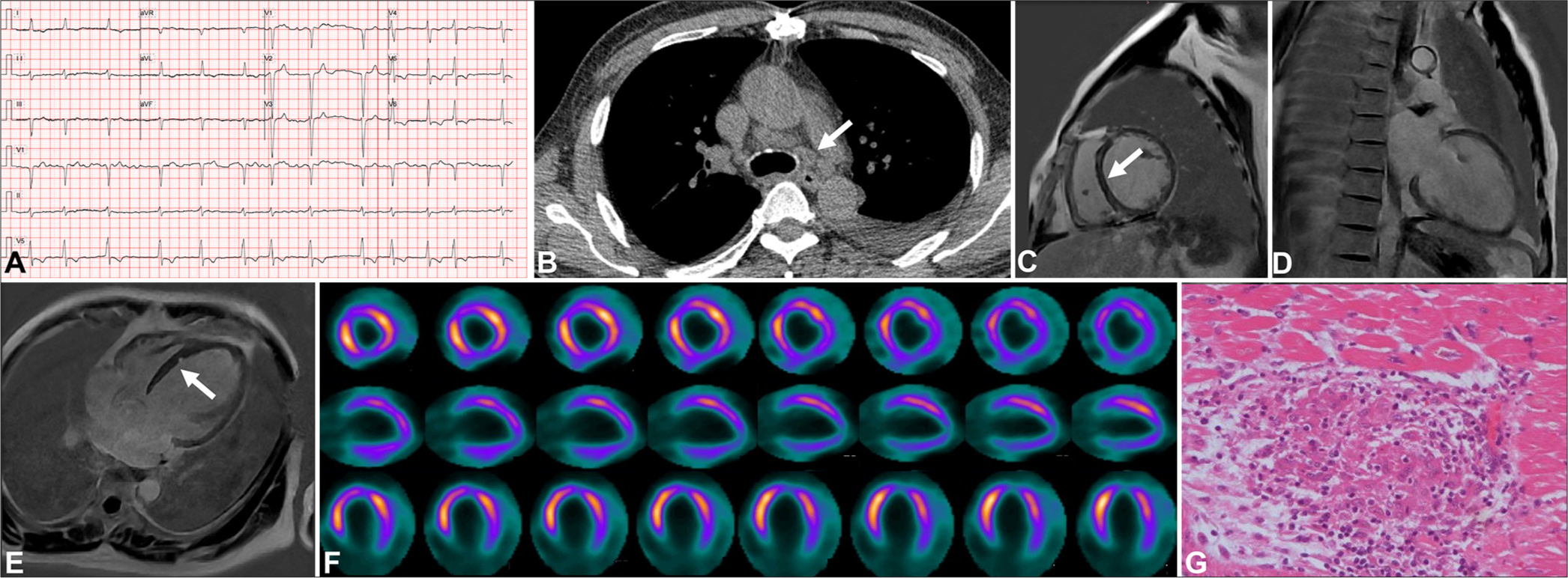 Imaging findings for a 57-year-old patient with a dilated cardiomyopathy-like phenotype of cardiac sarcoidosis. (A) Electrocardiogram showed atrial fibrillation. (B) Computed tomography revealed extracardiac lymphadenopathy (white arrow). (C-E) Cardiac magnetic resonance displayed scattered mid myocardial late gadolinium enhancement areas in the basal interventricular septum (white arrow in sub-figures C and E). (F) 18F-fluorodeoxyglucose (FDG)-positron emission tomography revealed no significant focal FDG update. (G) Photomicrographs illustrated lesions in a heart explant specimen composed of non-caseating epithelioid granulomas ((Hematoxylin-eosin HE), x20).