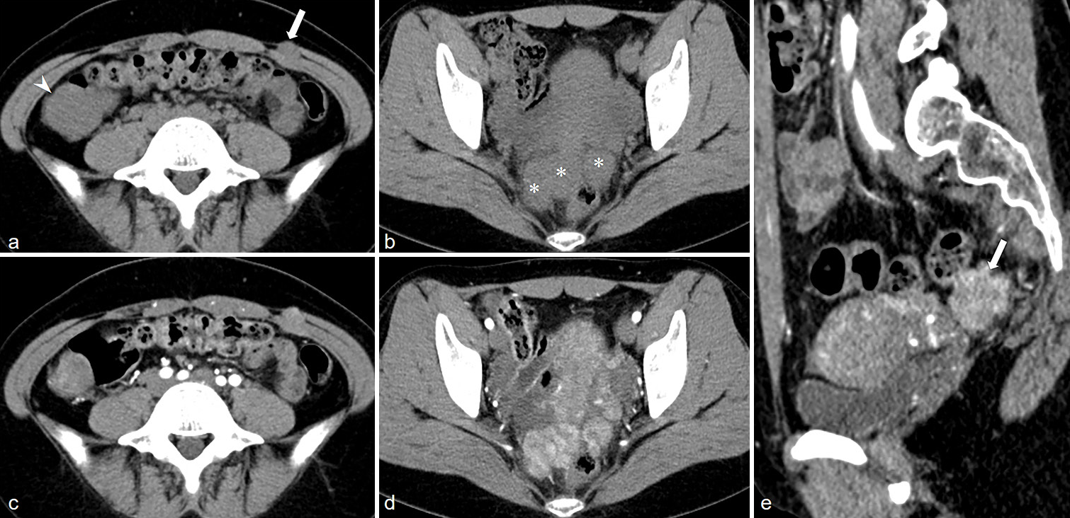 A 21-year-old woman with LPD. (a) Axial non-enhanced CT image showed soft tissue nodules in the left abdominal wall (white arrow), right abdominal cavity (white arrowhead) . (b) Axial non-enhanced CT image showed multiple soft tissue nodules in the rectouterine pouch (*) with uniform density. (c and d) Axial CT images on arterial phase showed slightly heterogeneous enhancement in the lesions, and the enhancement patterns of all lesions were similar. (e) Sagittal CT images on arterial phase, and the enhancement of the lesion was similar to that of the myometrium (white arrow). (LPD, Leiomyomatosis peritonealisis disseminata; CT, Computed tomography.)