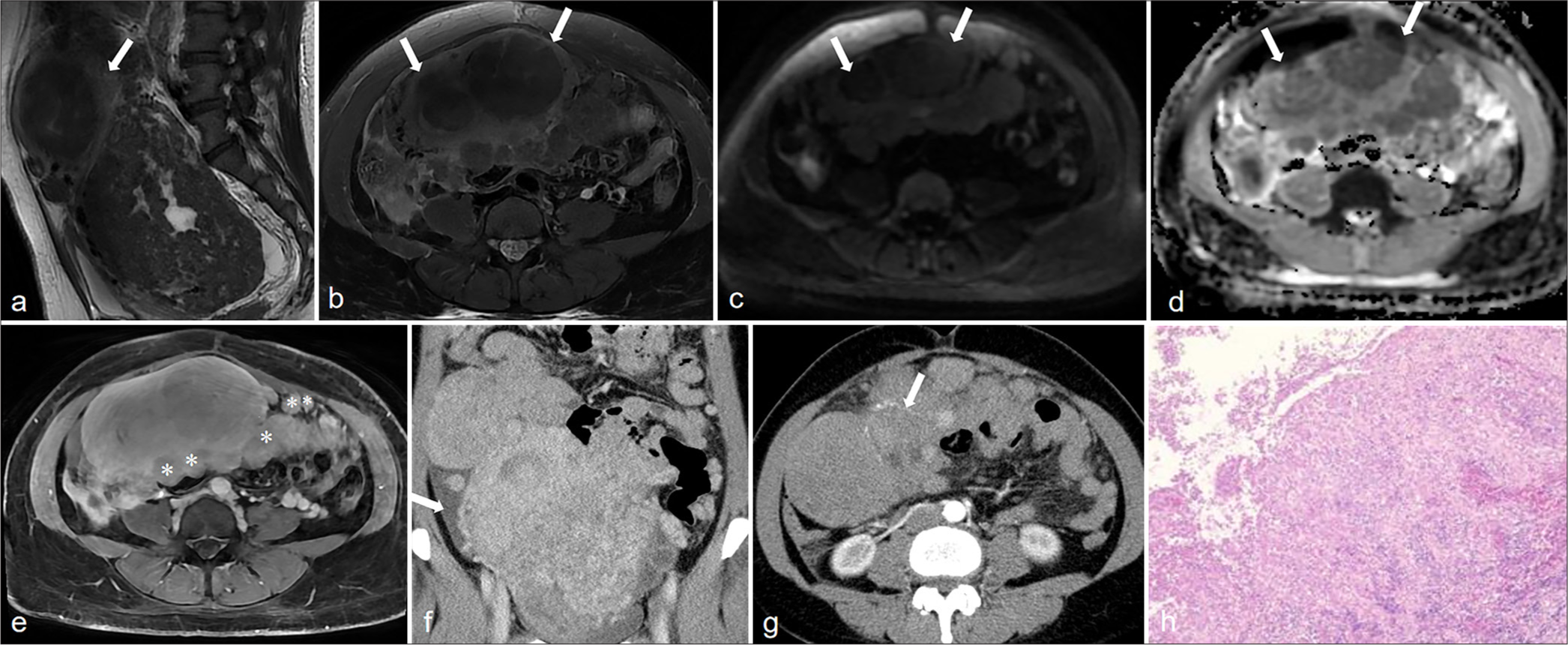 A 48-year-old woman with LPD. (a) Axial T1WI image showed a hypointense soft tissue mass in the abdominal cavity (white arrow). (b) The lesion edge showed high signal intensity on Axial T2WI image (white arrows). (c) The DWI showed isointense (white arrows). (d) The ADC showed hypointense (white arrows). (e) There were also many nodular abnormal signals in the abdominal cavity (*), some of which were closely related to the peritoneum, and obvious homogeneous enhancement was observed; (f) On the CT venous phase, the huge mass in the abdomen cavity showed uneven and obvious enhancement, and a small amount of fluid (white arrow) could be seen in the abdominal cavity. (g) The lesions on the CT arterial phase showed patchy enhancement with vascular shadows (white arrow). (h) The microscope showed that the tumor was composed of spindle cells (Hematoxylin and eosin, ×40 magnification). (LPD: Leiomyomatosis peritonealis disseminate, MRI: Magnetic resonance imaging, T1WI: T1-weighted imaging, T2WI: T2-weighted imaging, DWI: Diffusion weighted imaging, ADC: Apparent diffusion coefficient).