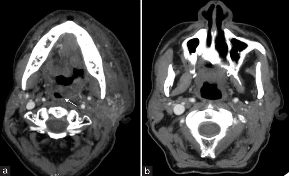 A 59-year-old man with a history of carcinoma of the base of the tongue status post-radiation treatment presenting for symptoms of worsening dysphagia and dyspnea. (a) Axial contrast-enhanced computed tomography (CT) image demonstrates irregular mucosal nodularity along the left base of the tongue and posterolateral oropharyngeal wall. Note the significant resultant narrowing of the oropharyngeal lumen posterior to the uvula (white arrow), This obstruction has rapidly grown from the axial contrast-enhanced CT image approximately 1 month prior, (b) which demonstrated relative patency of the lumen.