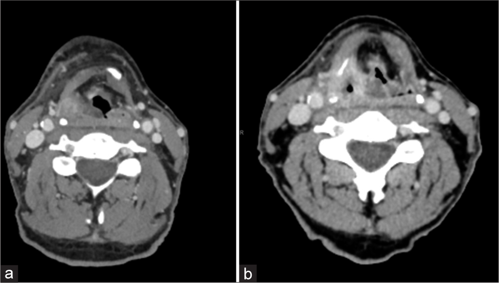 A 62-year-old man with biopsy-proven squamous cell carcinoma status post high-dose radiation treatment. Computed tomography (CT) images demonstrate submucosal edema in the posterior pharyngeal wall causing supraglottic airway stenosis (b), which progressed from the prior CT soft tissues of the neck approximately 6 months prior (a). Imaging was obtained just over 2 weeks into the start of a 6-week radiation treatment course. (CT: computed tomography)