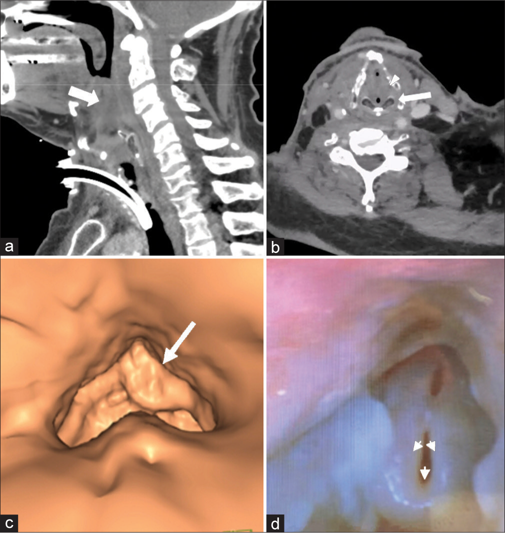 A 63-year-old man with a history of p16 positive tonsillar squamous cell cancer s/p chemoradiation, completed 3.5 years prior. Serial outpatient cancer surveillance endoscopies showed stable curled epiglottis and arytenoid edema. Later, the patient presented acutely with several hours of increased dyspnea and inability to speak in full sentences. In (a and b) sagittal and axial contrast-enhanced computed tomography images demonstrate severe edema of the supraglottic airway (white arrow), bilateral aryepiglottic folds (white arrowhead), and vocal folds (white arrow). (c) Reformatted images of endoscopic view with left greater than right supraglottic obstruction (large white arrow). (d) Endoscopic images after emergent tracheostomy and 12 h of racemic epinephrine and Decadron still demonstrate significant edema through the supraglottic larynx and a curled “omega-shaped” epiglottis that collapses with inspiration (small white arrows).