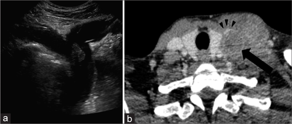 A 41-year-old woman with a history of metastatic melanoma status post-chemotherapy. (a) Sonography demonstrates a thrombus in the lower internal jugular vein (IJV), extending into the brachiocephalic vein. (b) Axial contrast-enhanced computed tomography image demonstrates a large necrotic lymph node (black arrow) compressing and nearly completely occluding the left IJV (black arrowhead).