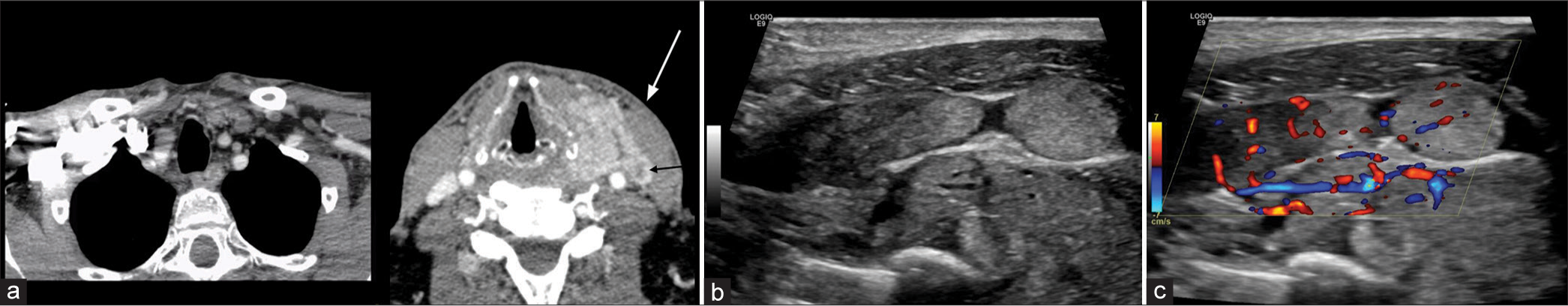 A 58-year-old man with a history of metastatic renal cell carcinoma presenting with palpable nodular enlargement of the thyroid gland as well as a left neck mass. (a) Axial computed tomography images demonstrate multinodular enlargement of the thyroid gland with extracapsular extension on the left into the adjacent visceral space, suspicious for tumor extension into the left internal jugular vein (IJV) (tumor thrombus, white and black arrows). (b and c) Ultrasound performed demonstrates contiguous extension of tumor from the thyroid into the left IJV with color Doppler showing increased vascularity throughout the tumor thrombus.