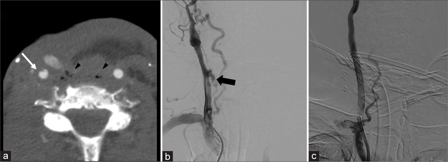 A 72-year-old man with a history of laryngeal squamous cell cancer after chemoradiation who subsequently developed laryngeal recurrence now status post salvage laryngectomy, pharyngectomy, and partial glossectomy is presenting with balance issues and ear pain. (a) Axial computed tomography angiogram of the neck demonstrates focal dissecting pseudoaneurysm of the right common carotid artery (CCA) (white arrow) with adjacent soft-tissue gas/necrosis (black arrowhead). Soft-tissue findings alone warrant prompt notification by the radiologist as this finding represents a threatened blowout. In this instance, a dissecting pseudoaneurysm elevates this to an impending blowout. (b) Digital subtraction angiography (DSA) demonstrates clear active extravasation from mid-CCA, representing an acute carotid blowout requiring intervention (black arrow). (c) DSA post-treatment shows covered stent graft placement.