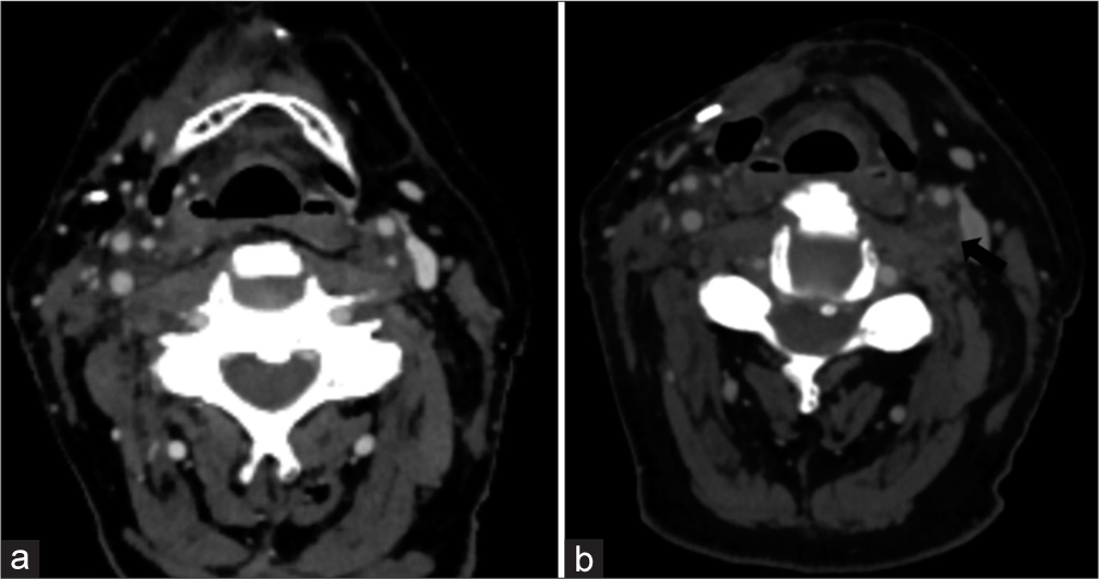 A 77 year old male (a) Demonstrates atherosclerotic disease within the left internal carotid artery with a focal 60% stenosis of the proximal portion. (b) Demonstrates complete occlusion of the left internal carotid artery at this level approximately 1 year later. The images demonstrate the rapid rate of occlusive changes in patients with prior radiation. The patient received 60 Gy over 30 fractions to the right surgical bed and cervical lymph node levels I–V, as well as 52.5 Gy over 30 fractions to the left cervical lymph node levels II–IV.