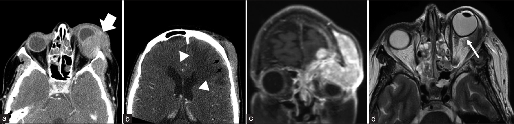 A 64-year-old woman with several weeks of left eye swelling, pain, and drainage leading to concern for orbital cellulitis. (a) Axial contrast computed tomography demonstrates a large lobulated soft-tissue mass centered within the left orbit involving both pre-septal and post-septal soft tissues (white arrow). (b) Demonstrates extension along the left inferior anterior cranial fossa where there is dural-based enhancement (black arrowheads) and parenchymal edema (white arrowheads). (c) Coronal T1 post-contrast images demonstrate a large contrast-enhancing mass with a mass effect on the adjacent intraorbital space. (d) Axial T2 at the level of the globe demonstrates proptosis and tenting of the posterior globe resulting in a “guitar pick” sign (white arrow), indicating increased intraocular pressure.