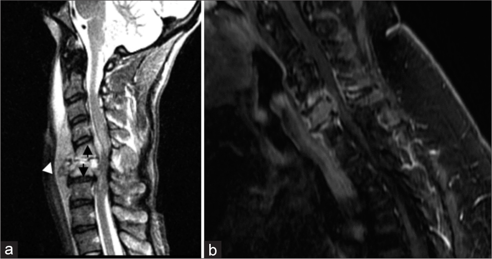 A 38 year old female (a) Demonstrates the typical destruction pattern of osteomyelitis, which begins in the avascular disc space as can be seen by the complete collapse of the C5–6 disc space (white arrowhead). Furthermore, destructive changes and marrow edema are seen extending upward from the disc space (black arrows) most notably at the adjacent endplates. Prevertebral and ventral epidural fluids are also present. In contrast, (b) demonstrates a focal metastasis centered in the highly vascularized C6 vertebral body. The disc spaces are preserved and there is adjacent reactive endplate edema without erosion.