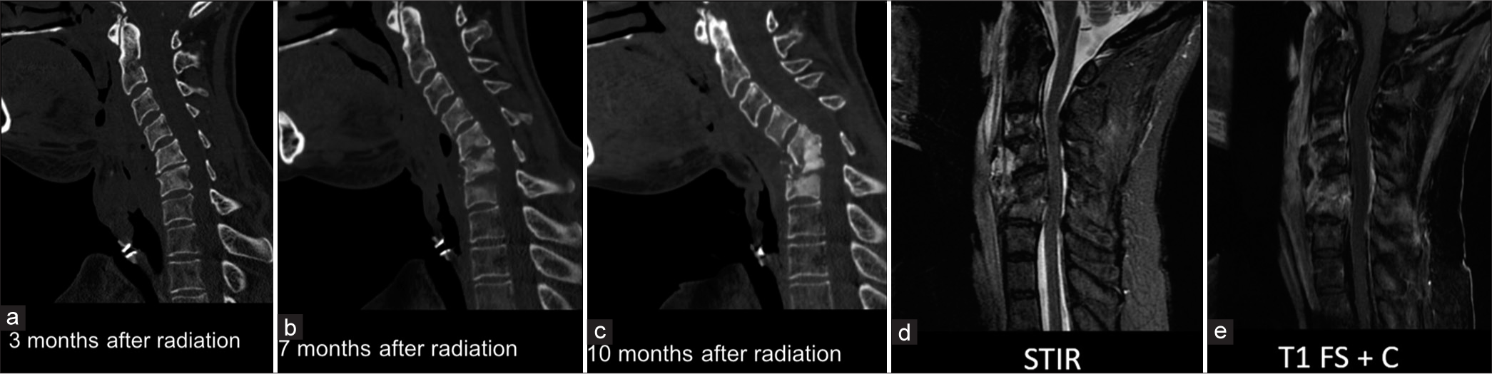 A 56-year-old woman with a history of laryngeal cancer after total laryngectomy and adjuvant radiation completed 2 years prior presents with neck pain. (a-c) sagittal computed tomography neck in the bone window showing the progression of osteoradionecrosis 3, 7, and 10 months after radiation. (d and e) MRI images show heterogeneous short tau inversion recovery signal, a non-enhancing prevertebral collection spanning C4–C5, mixed sclerosis, and edema/enhancement with the C3–C5 vertebral body marrow. Notably, there is no fluid in the disc spaces, which would be more suggestive of infection.