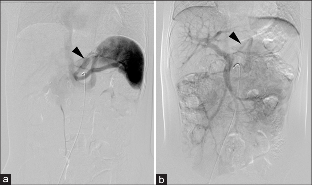 A 2.5 year old male was admitted and underwent angiography to assess the congenital portosystemic shunt and its potential closure option. (a) Celiac artery angiogram shows blood flow through the shunt from the splenic vein to the left gastric vein and left renal vein (black arrowhead). (b) The superior mesenteric artery angiogram demonstrates the shunt from the portal vein to the left gastric vein and left renal vein (black arrowhead).