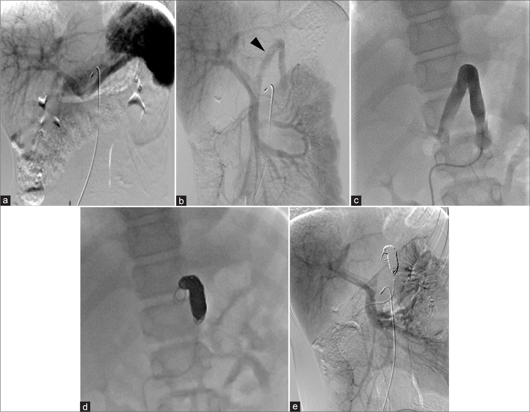 A 11 year old male was admitted and underwent angiography to assess the congenital portosystemic shunt and its closure procedure. (a) Celiac artery (CA) angiogram shows minimal visualization of the shunt. (b) Superior mesenteric artery (SMA) angiogram indicates more prominent shunt blood flow from the SMA-superior mesenteric vein (SMV) system (black arrowhead) compared to the CA-splenic vein system, suggesting a shift in flow dominance to the SMV. (c) Balloon occlusion demonstrates the shunt vessel with portal pressure measured at 6 mmHg, with no significant pressure gradient upon balloon release. (d) Coil embolization, starting from the top of the shunt’s inverted U-shape, using a total of 12 coils, was performed to preserve the normal left gastric vein and left renal vein. (e) Post-embolization angiography from the SMA confirms successful occlusion of the shunt, with no residual shunt flow observed.