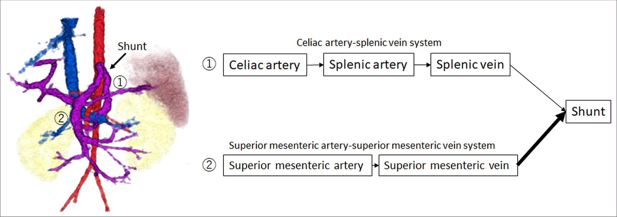 Schematic illustration of the shunt pathway, showing the shift in blood flow from the celiac artery-splenic vein system (①) to the superior mesenteric artery-superior mesenteric vein (SMA-SMV) system (②). This shift indicates a predominance of shunt blood flow from the SMA-SMV system, resulting in a larger portion of nutrient-rich mesenteric blood bypassing the liver and entering the systemic circulation directly.